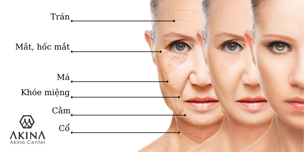 Nguyên nhân da chảy xệ sớm? Phương pháp căng da mặt bằng chỉ collagen