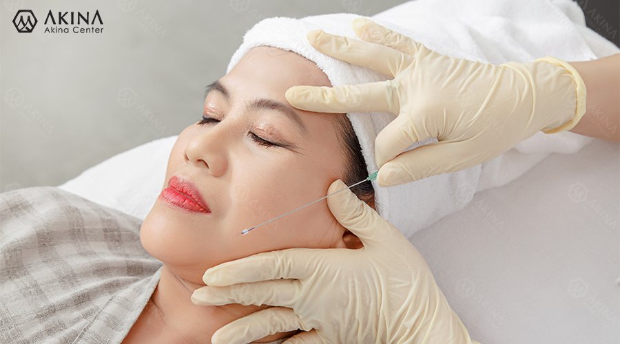 Điều trị sẹo rỗ tại Huế với phương pháp căng chỉ da