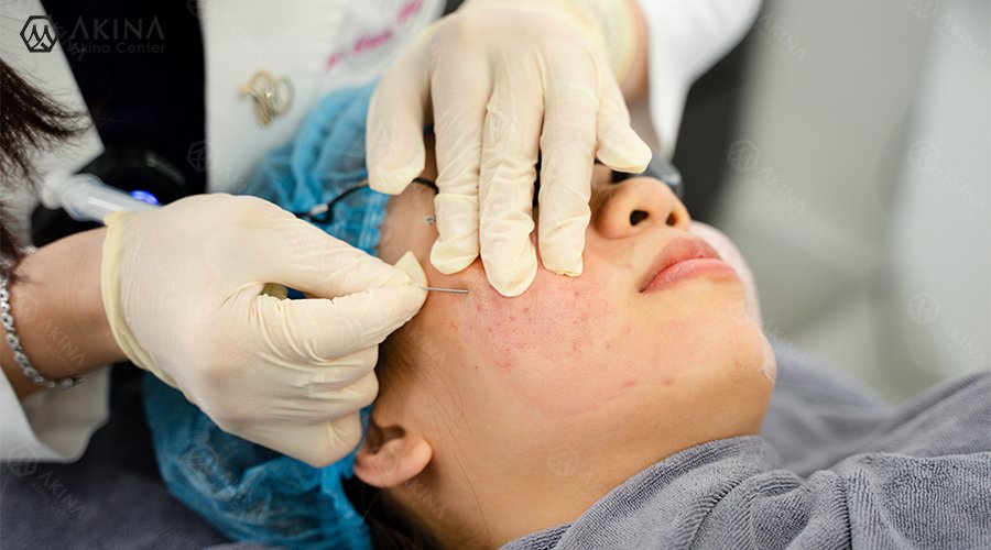 Điều trị sẹo rỗ tại Huế với phương pháp bóc tách đáy sẹo