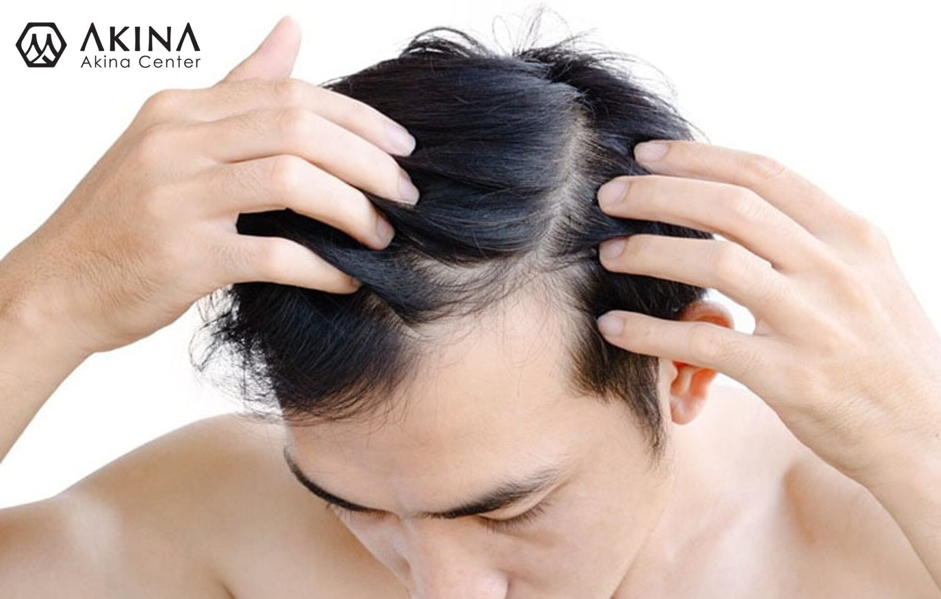 Có nhiều nguyên nhân khiến bạn rụng tóc - Điều trị rụng tóc, hói tóc tại Đà Nẵng