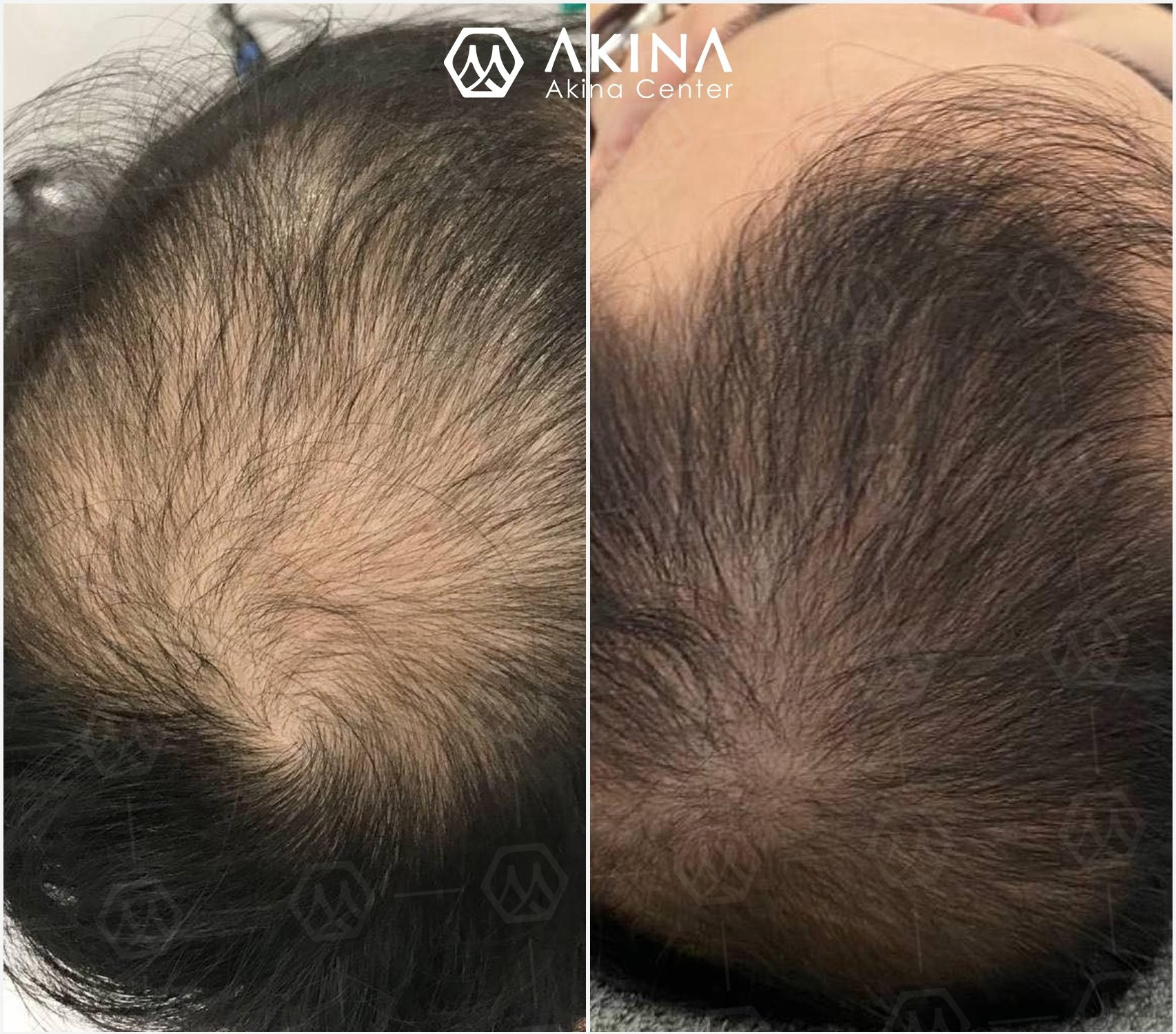Kết quả trị rụng tóc, hói tóc nội tiết tại phòng khám AKINA Đà Nẵng