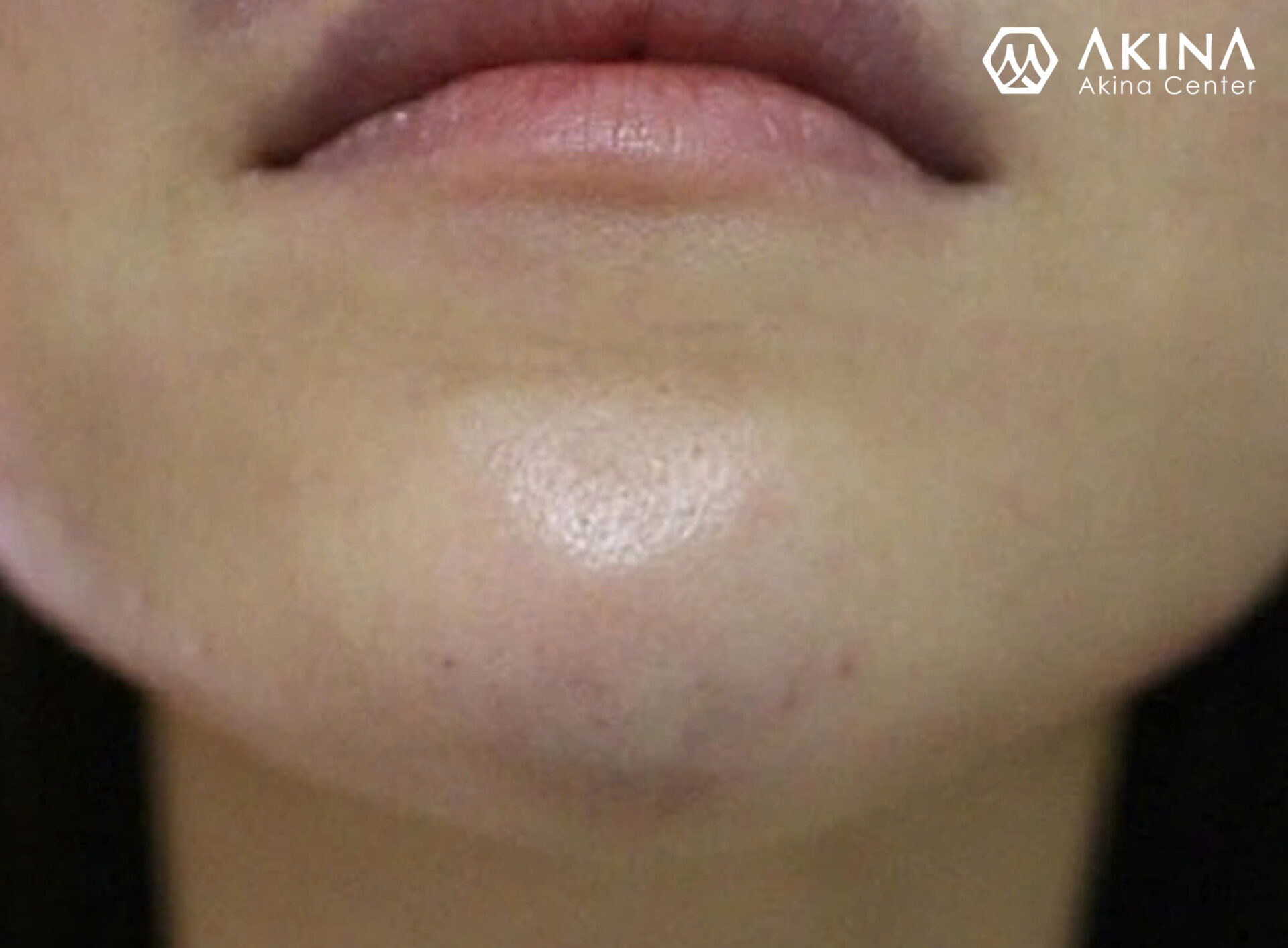 A close up of a person's chin

AI-generated content may be incorrect.